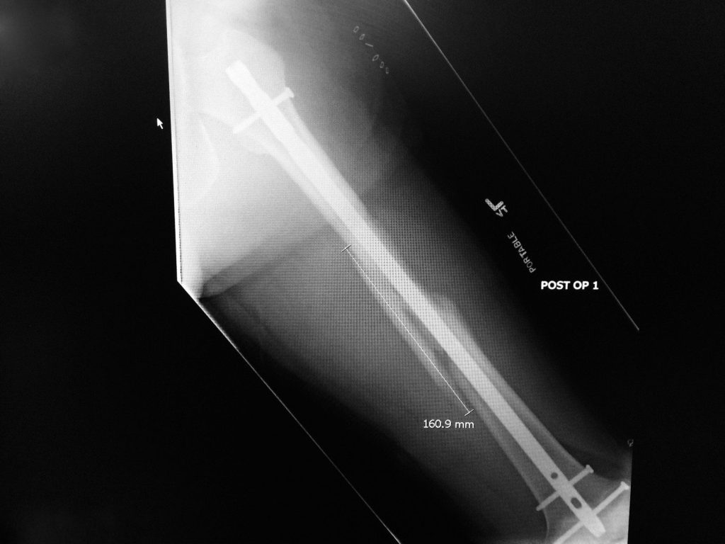 The fracture and nail that is now in my femur.