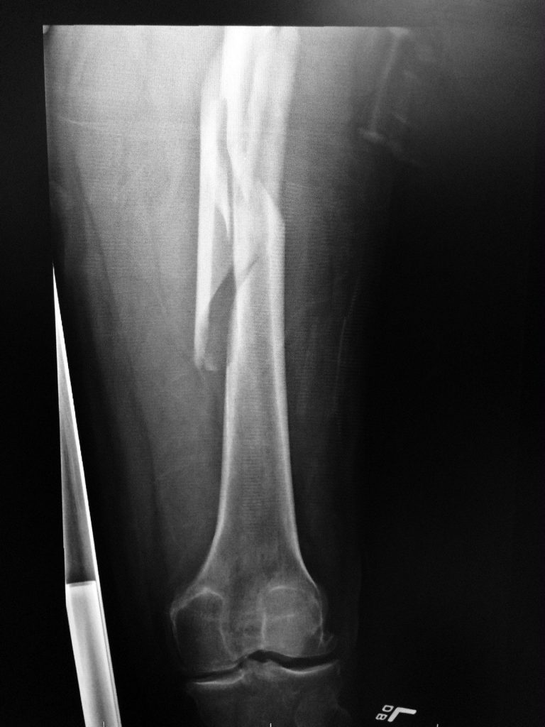 Wayne's femur x-ray.